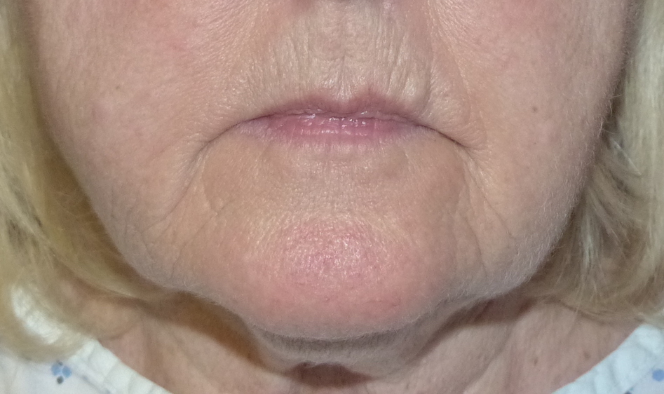 facelift crawley oliver harley cosmetic surgery