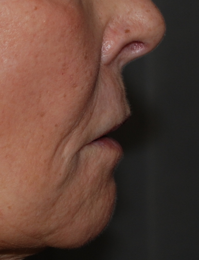 upper lip lift preop