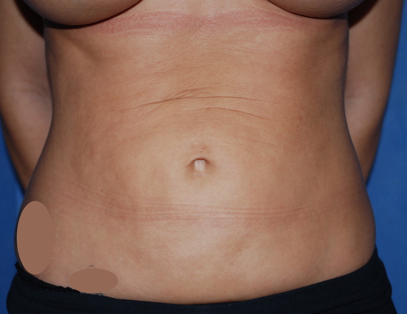 liposuction harley reigate cosmetic surgery