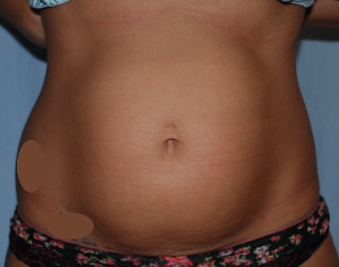 liposuction tummy horsham oliver harley