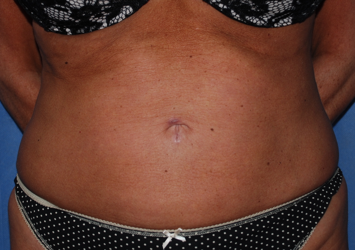 liposuction tummy harley mcindoe centre