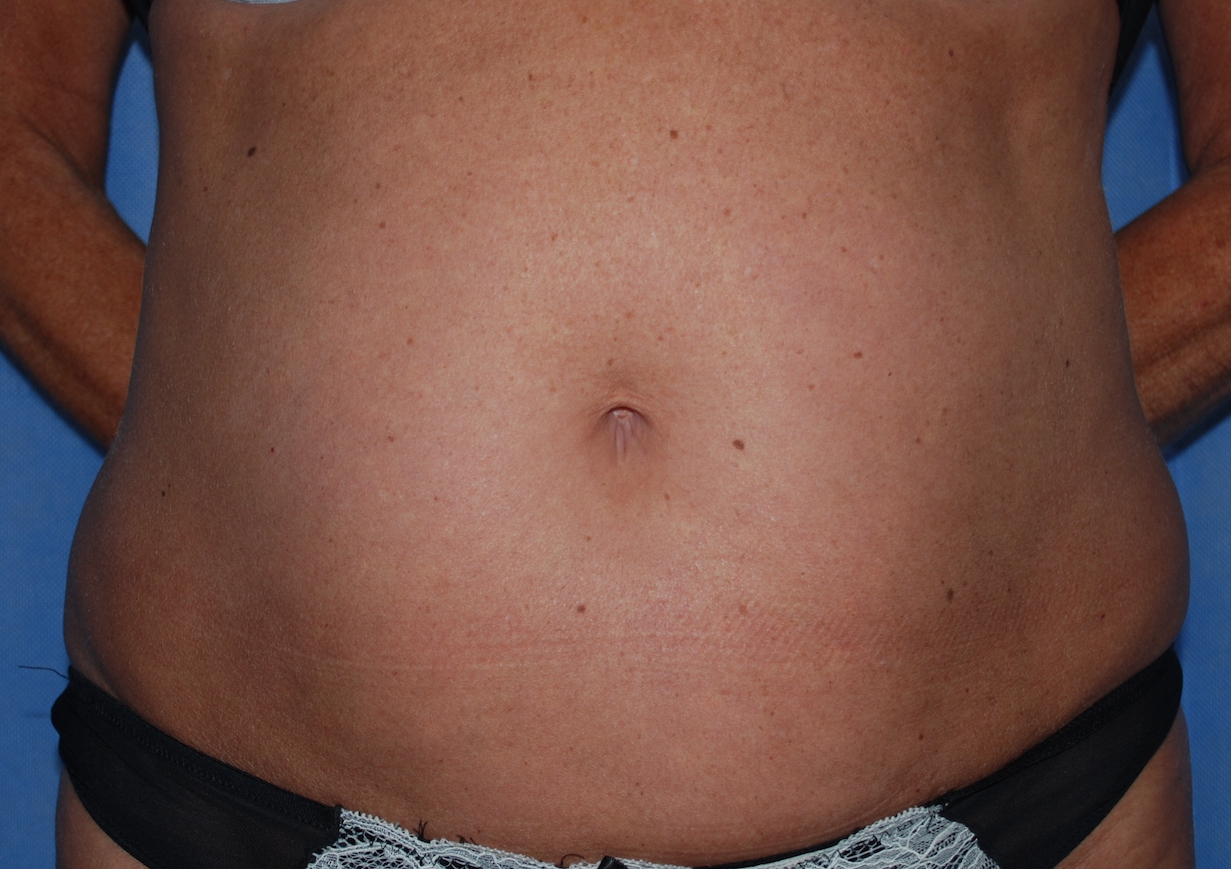liposuction tummy harley east grinstead