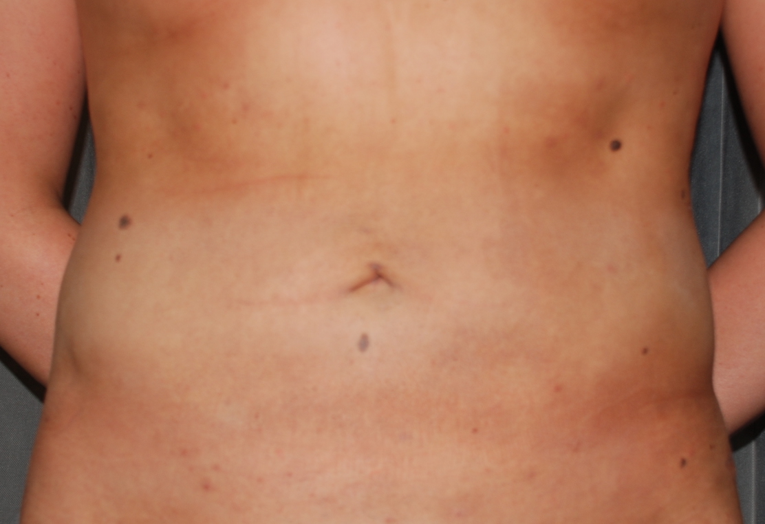 tummy liposuction harley cosmetic maidstone