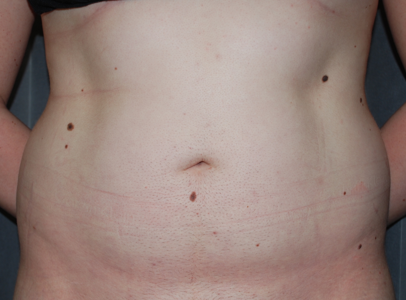 liposuction tummy KIMS hospital kent