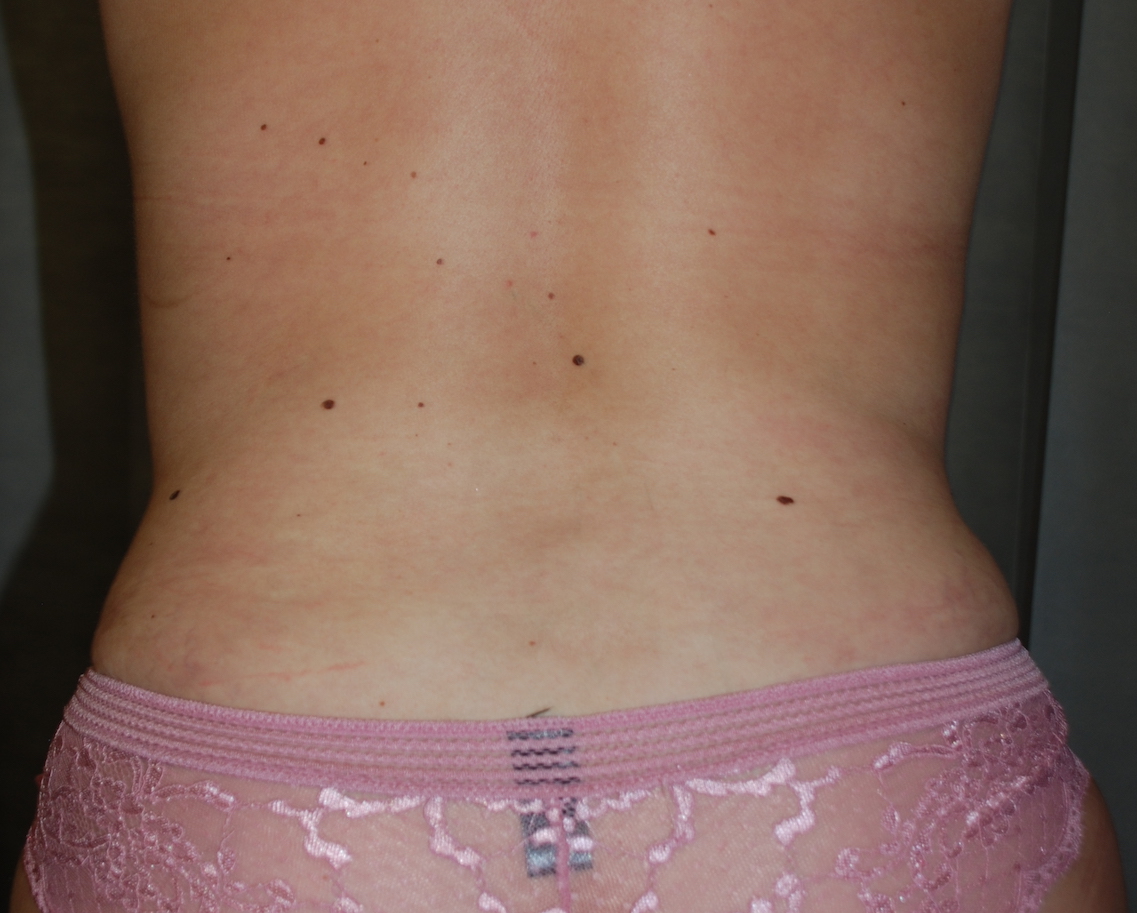 liposuction hips KIMS hospital kent cosmetic