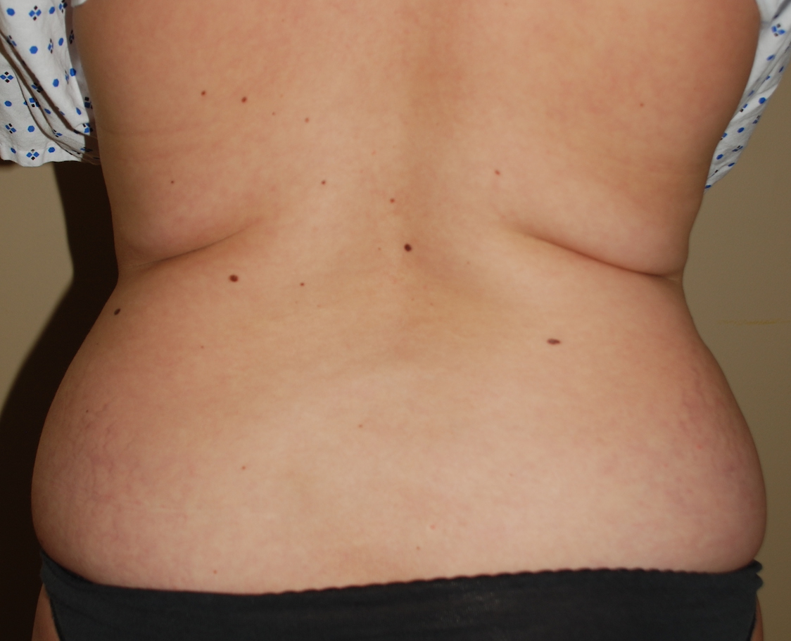 liposuction hips cosmetic surgery sussex