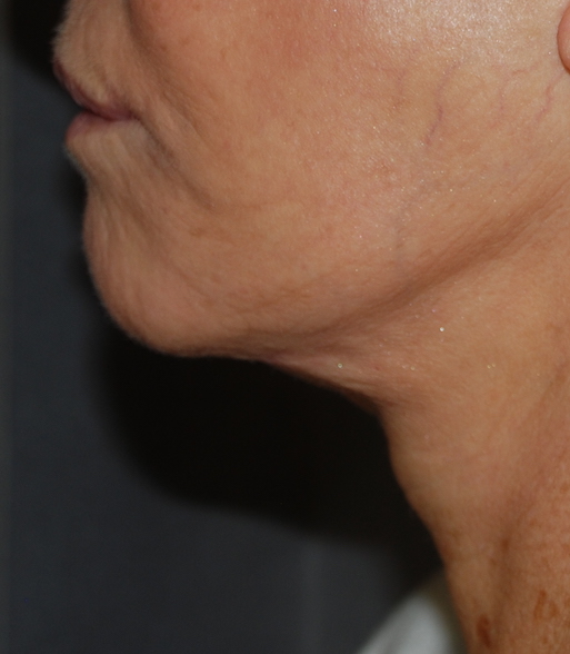 neck lift harley cosmetic surgery