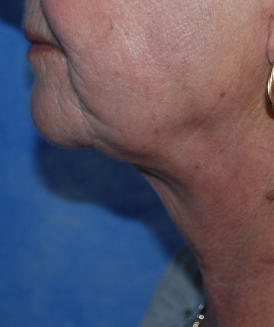 neck wrinkles cosmetic mcindoe centre