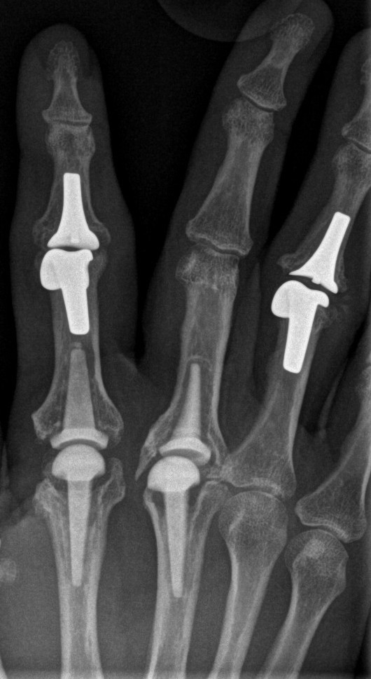 finger joint replacement x-rays