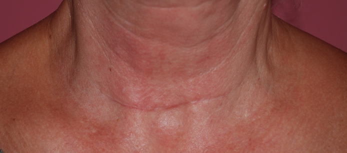 thyroid scar revision after surgery