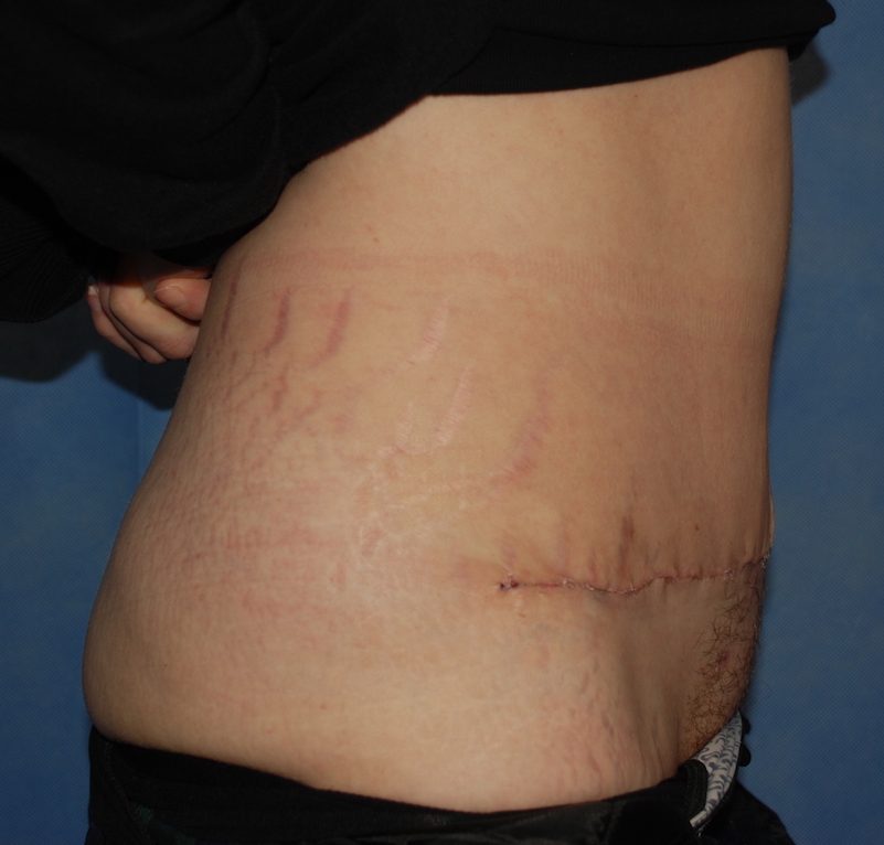 abdominoplasty harley post op