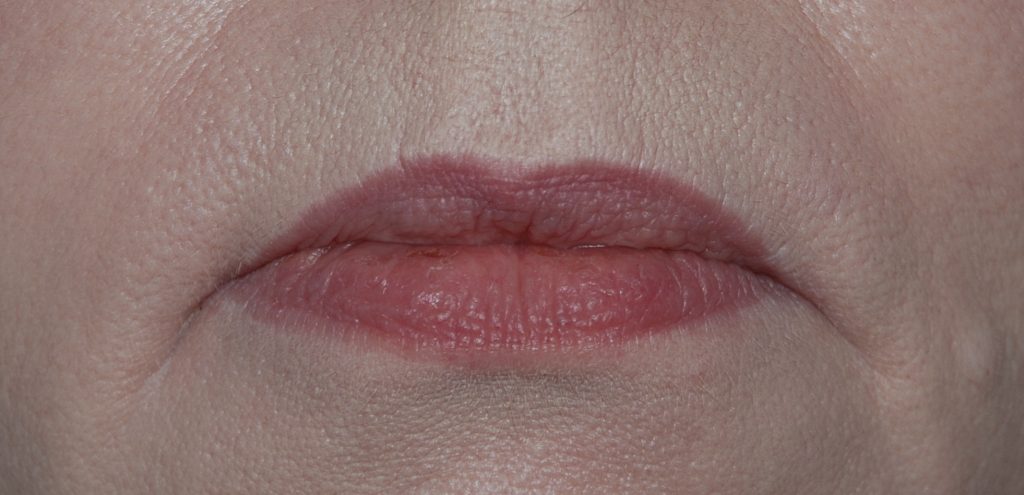 Valentine lip lift today – Happy valentines day – Harley Plastic Surgery