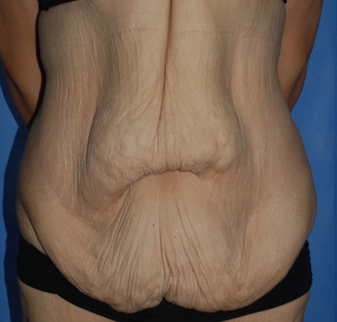 fleur de lis tummy tuck