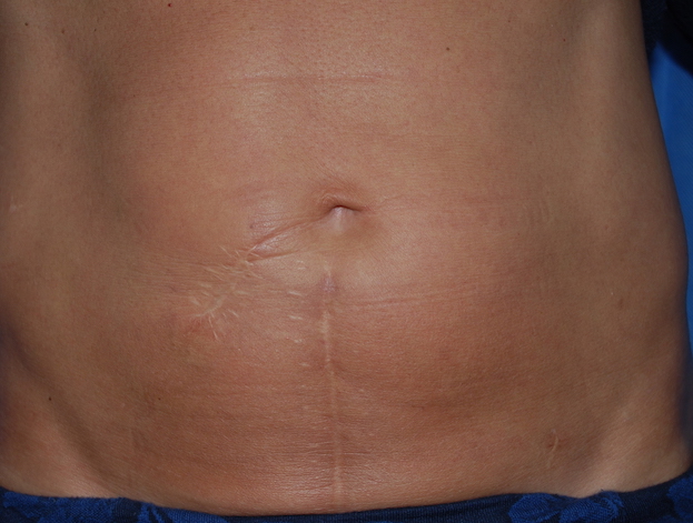 fat transfer scar correction sussex oliver harley