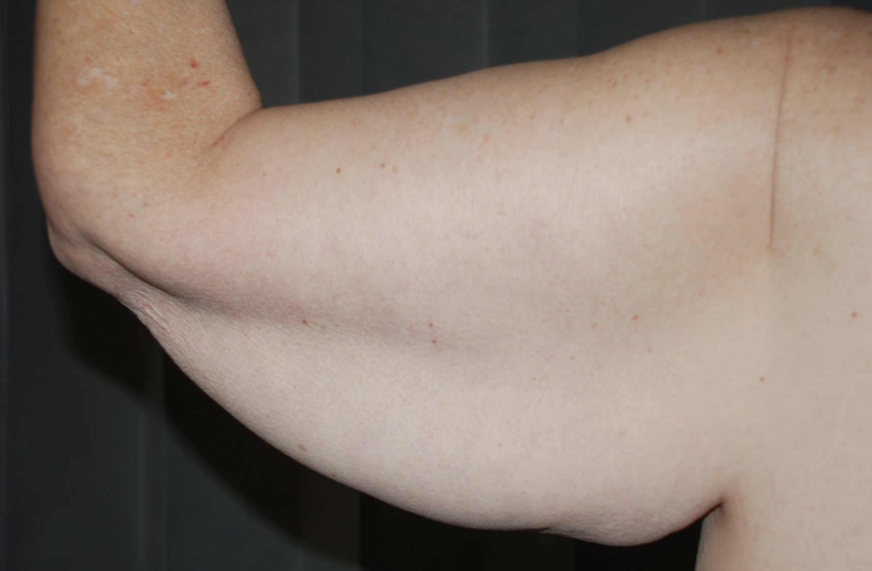 arm lift cosmetic surgery weightloss