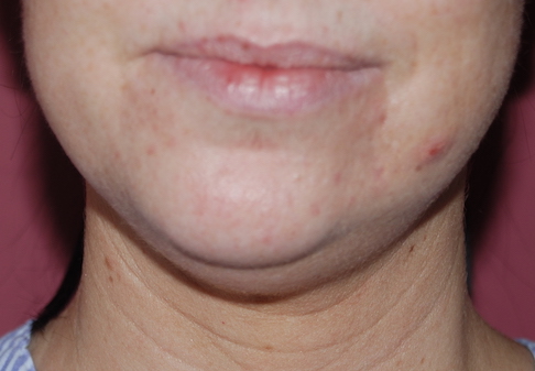 liposuction neck before op
