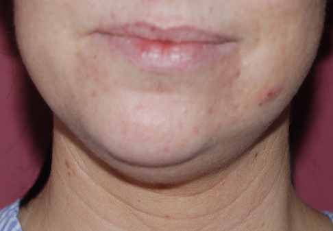 liposuction neck before op