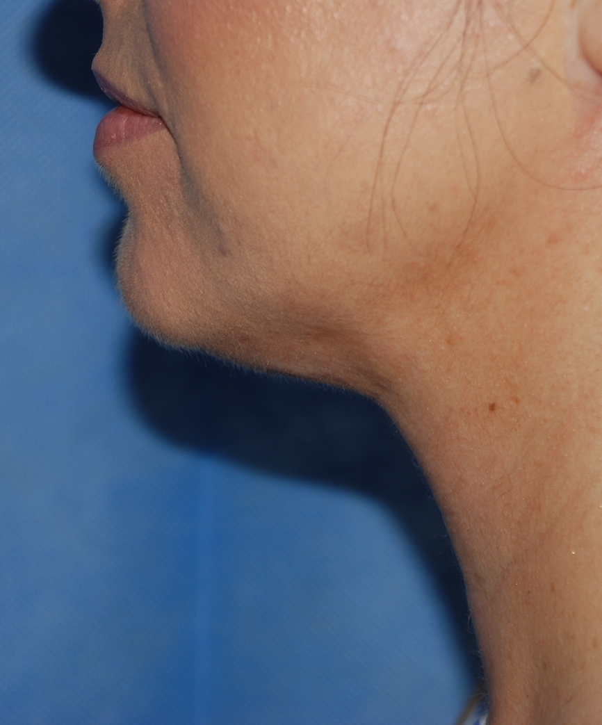 after neck liposuction
