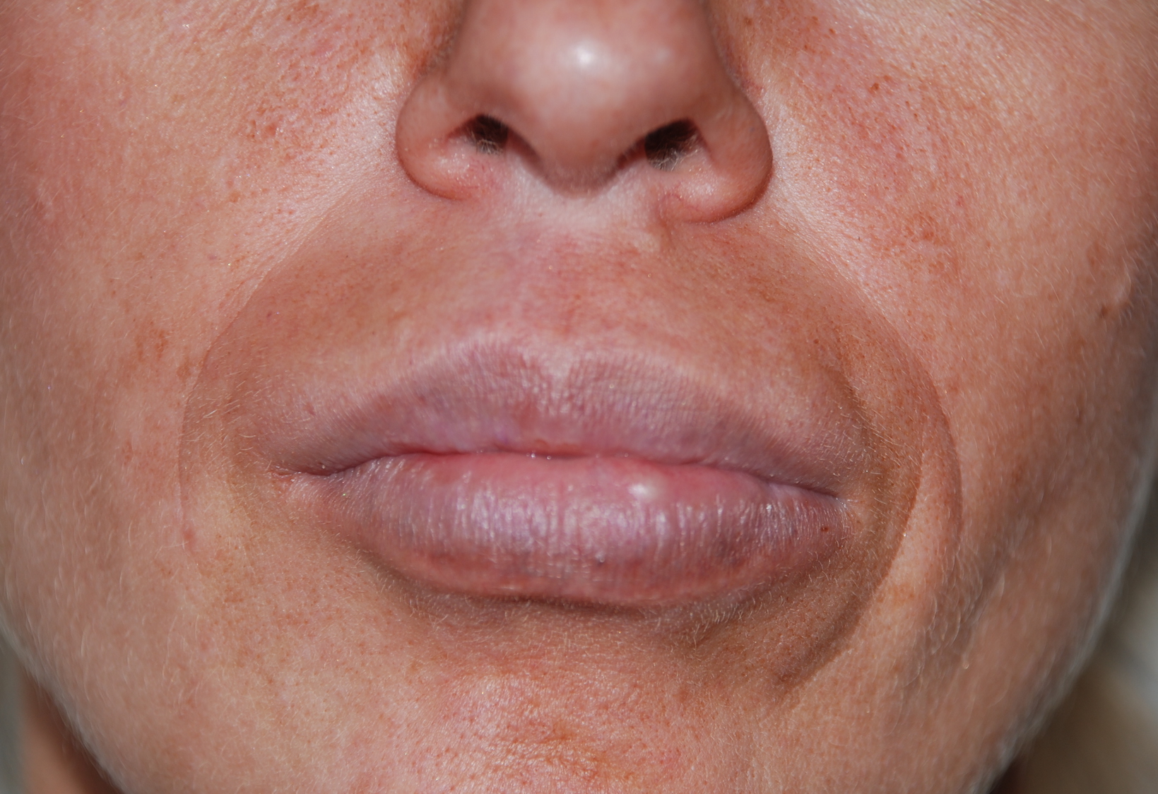 aquamid lip filler removal