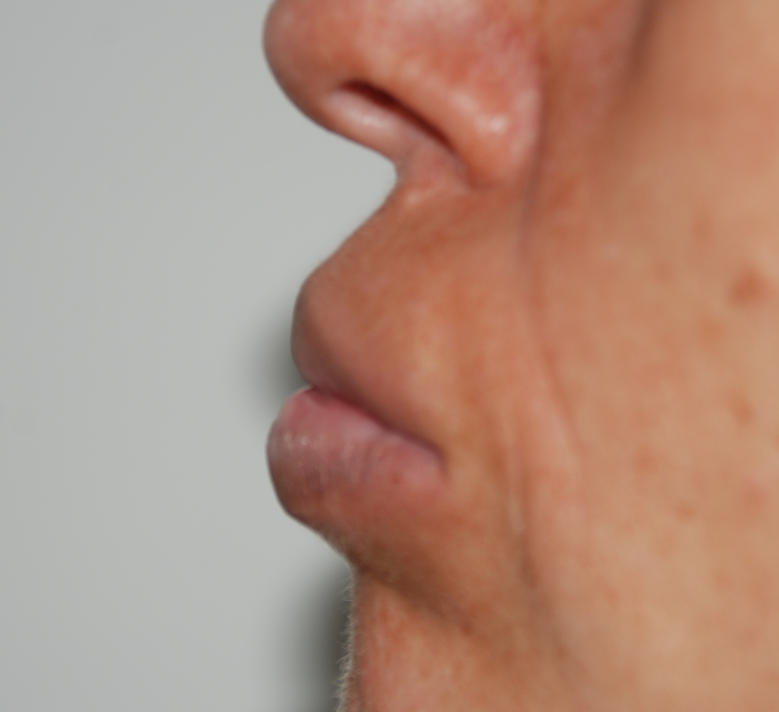 lip filler removal aquamid