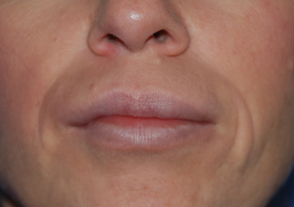 after aquamid lip filler removal