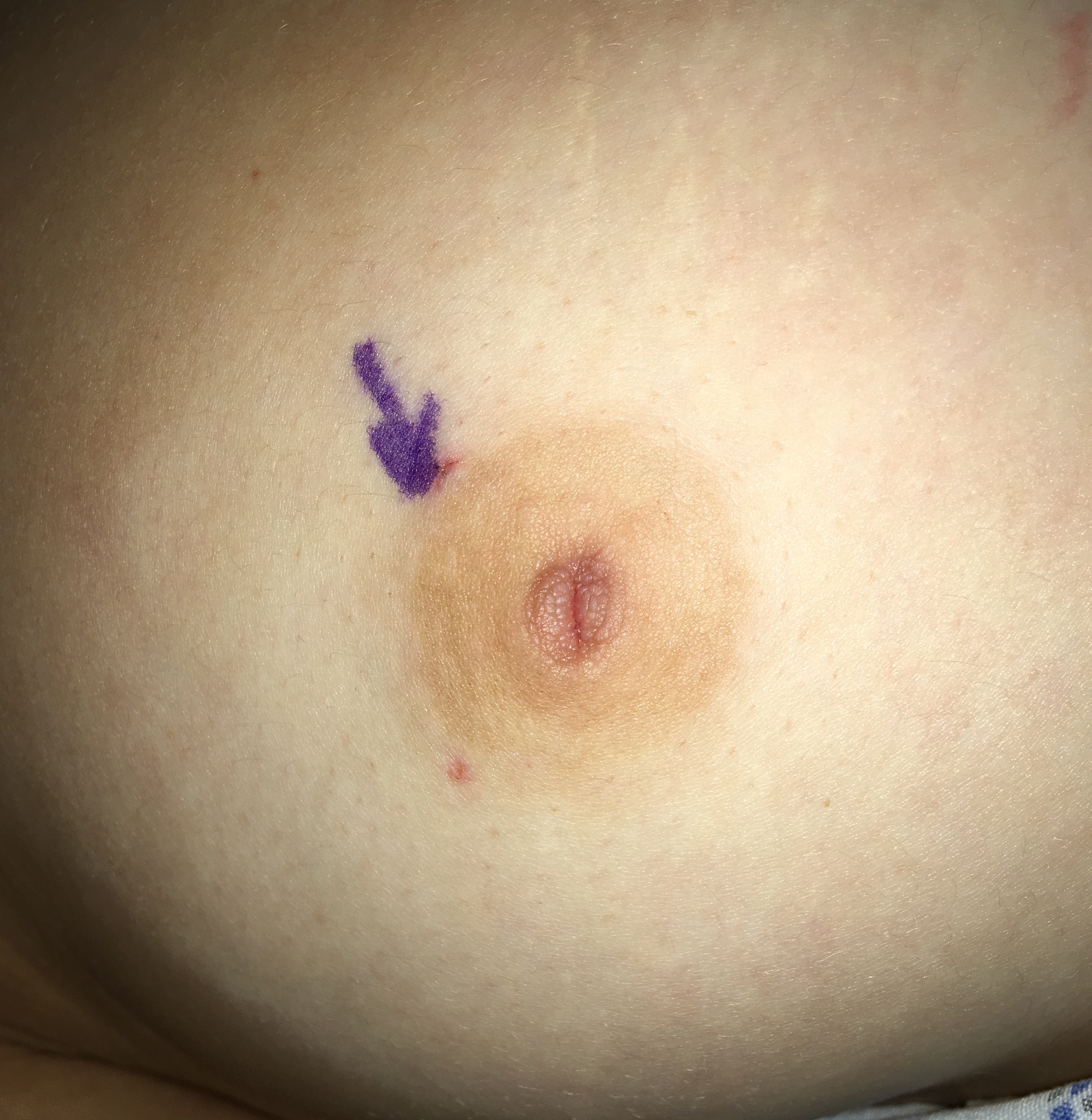 inverted nipple before correction