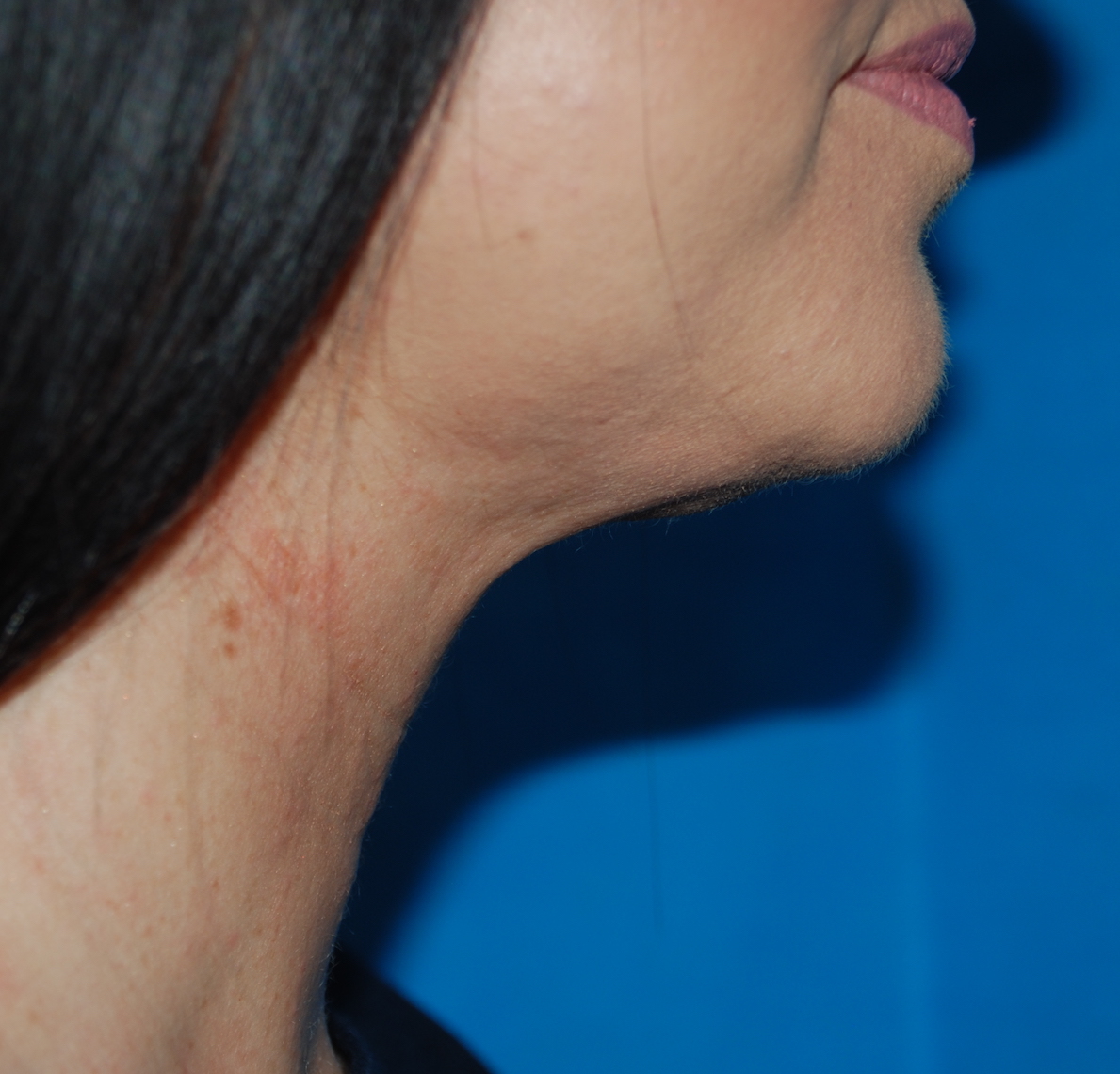 neck liposuction oliver harley plastic surgeon