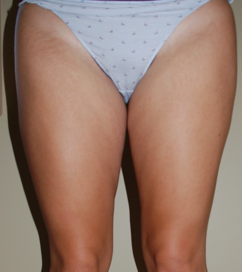 liposuction inner thighs pre op 