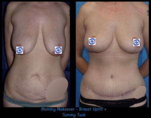 Oliver Harley Plastic Surgeon East Grinstead Sussex McIndoe Centre UK shows before and after pictures of Mommy Makeover operation. A lovely result to improve the shape of tummy and torso following children and weightless