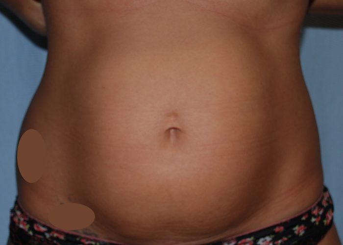 Liposuction Before