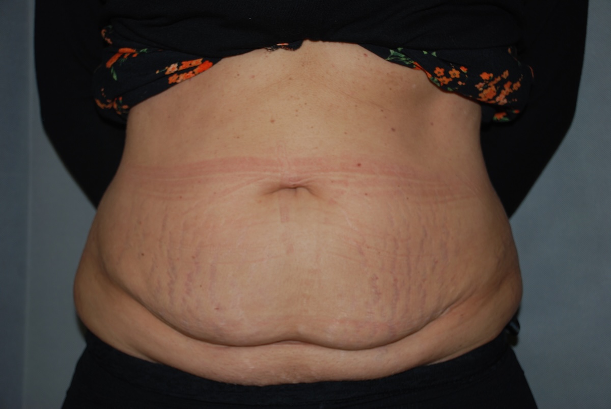 Tummy Tuck AA LTT Front Before Tummy Tuck AA LTT Front Before