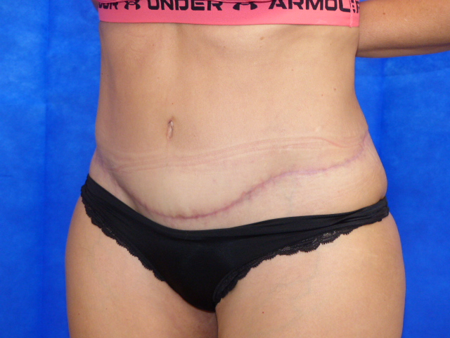 Tummy Tuck ES LTT Side After