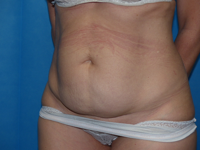 Tummy Tuck ES LTT Side Before Tummy Tuck ES LTT Side Before