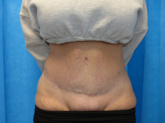 Tummy Tuck JT LTT Front After Tummy Tuck JT LTT Front After