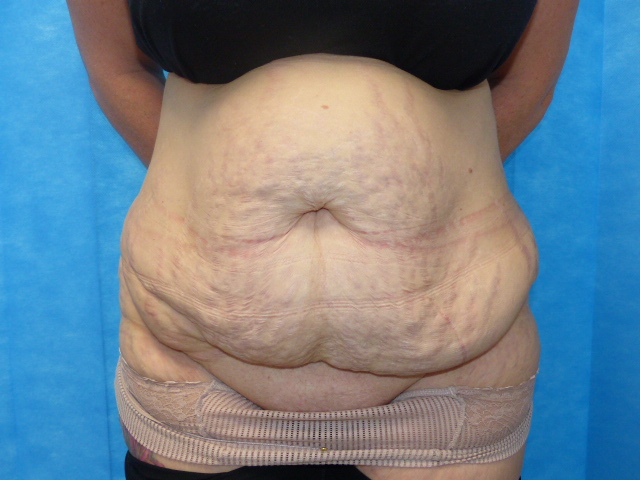 Tummy Tuck JT LTT Front Before