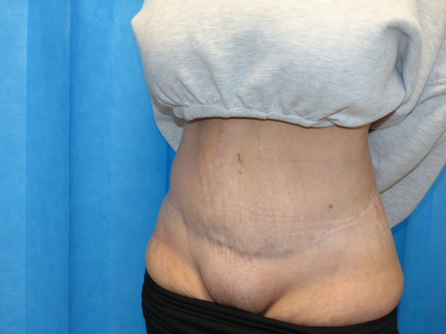 Tummy Tuck JT LTT Side After