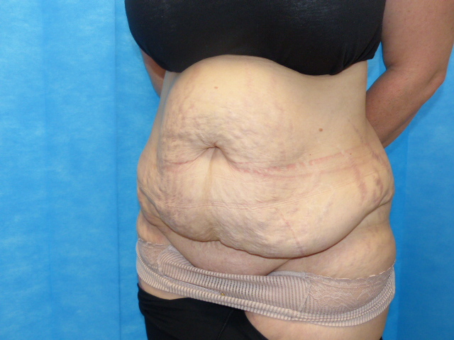 Tummy Tuck JT LTT Side Before Tummy Tuck JT LTT Side Before