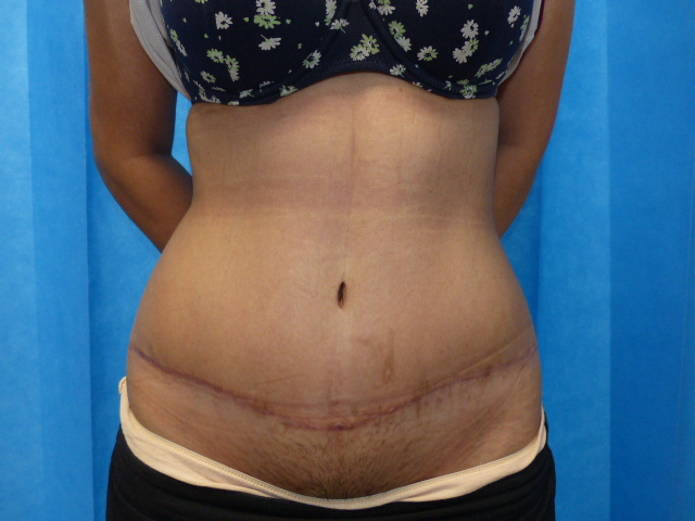 Tummy Tuck RC LTT Front After Tummy Tuck RC LTT Front After
