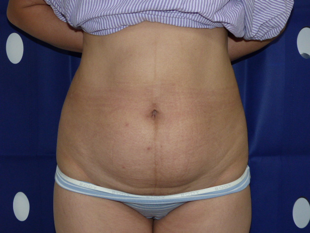 Tummy Tuck RC LTT Front Before Tummy Tuck RC LTT Front Before