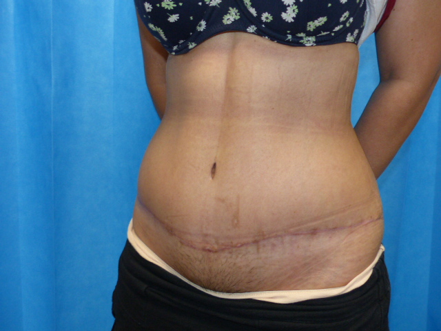 Tummy Tuck RC LTT Side After Tummy Tuck RC LTT Side After
