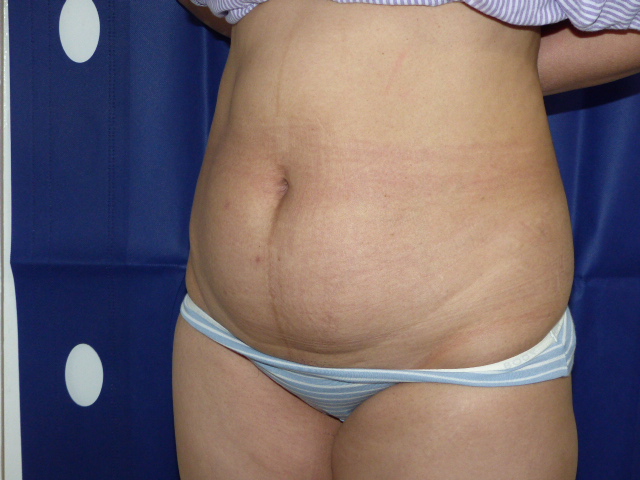 Tummy Tuck RC LTT Side Before