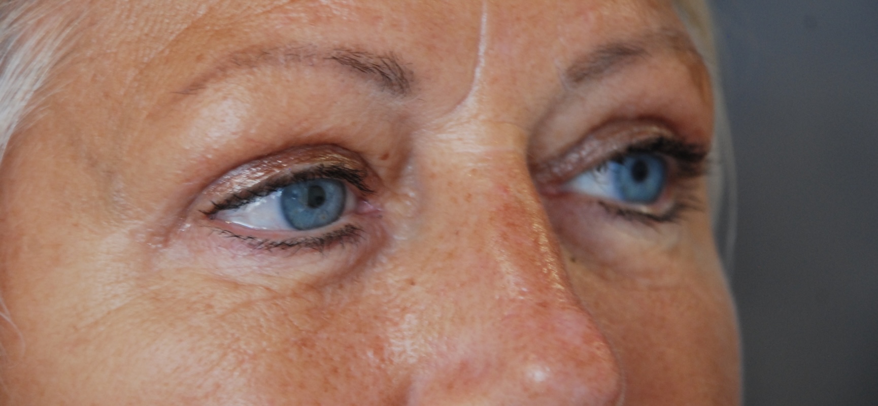 AC Upper Eyelid side After AC Upper Eyelid side After