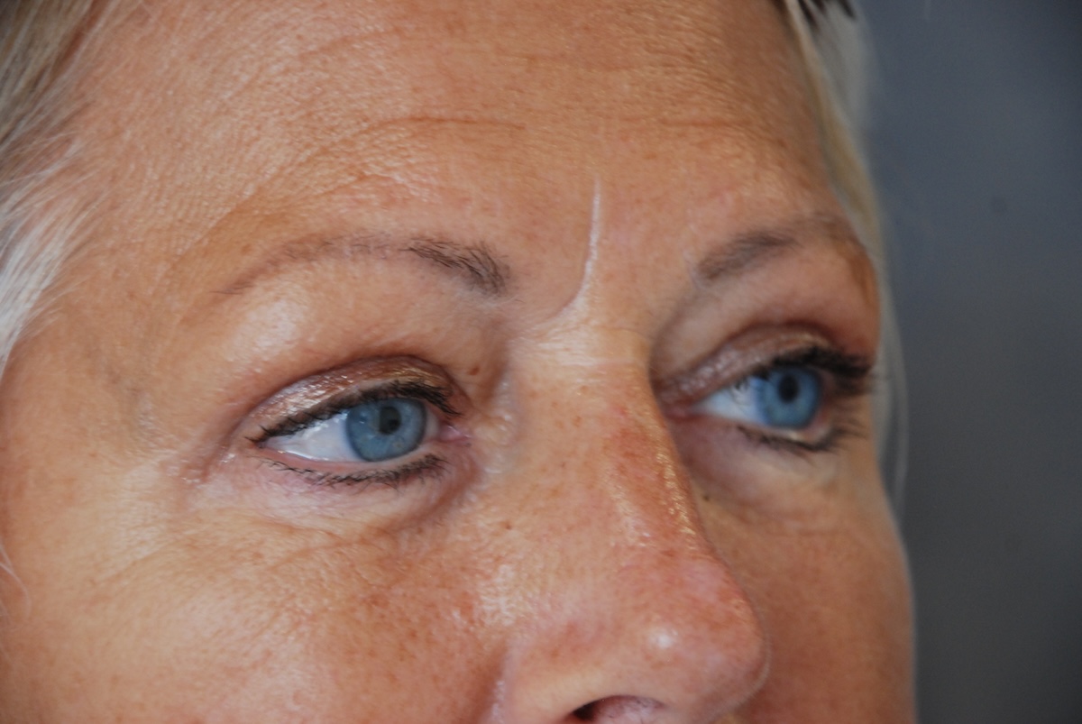AC Upper Eyelid side After