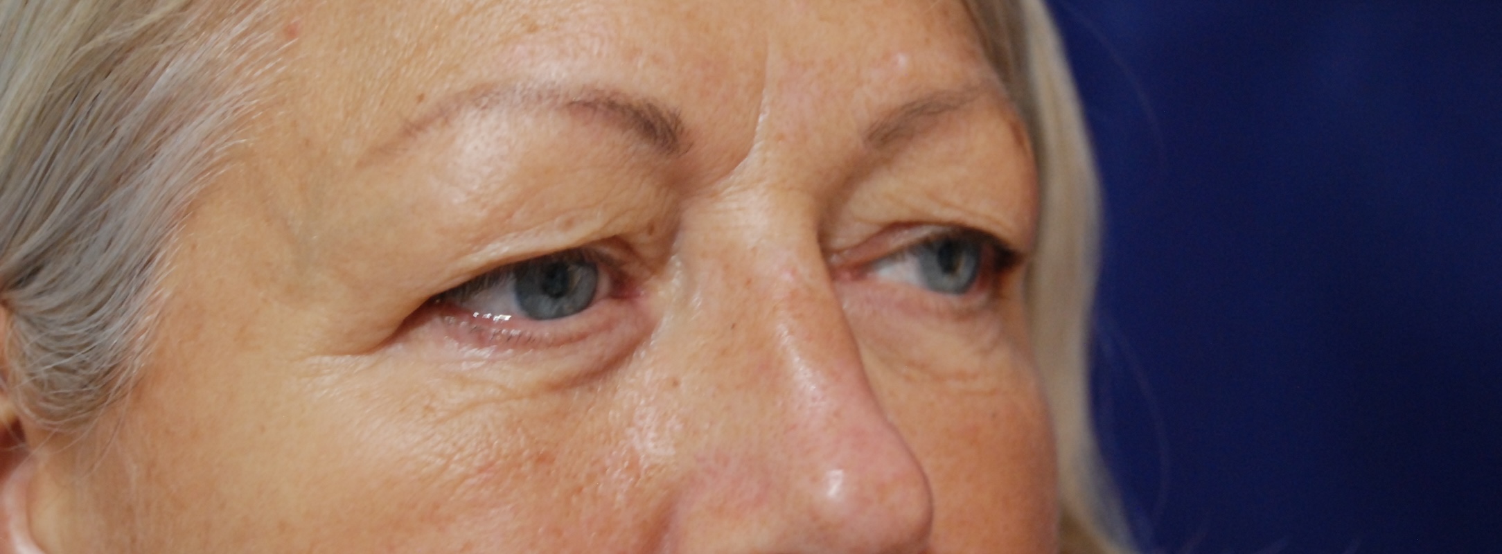 AC Upper Eyelid side Before AC Upper Eyelid side Before