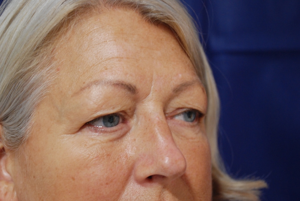 AC Upper Eyelid side Before AC Upper Eyelid side Before