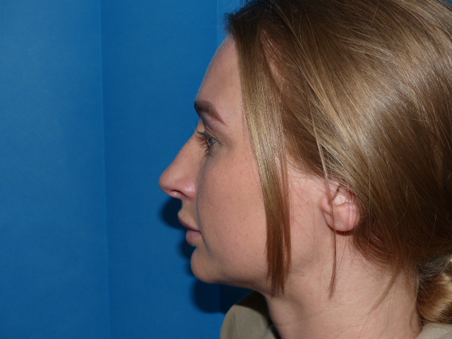 AL Rhino Nose job Before