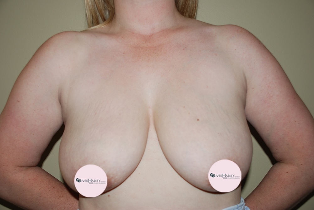 AS BU Breast Uplift Front Before