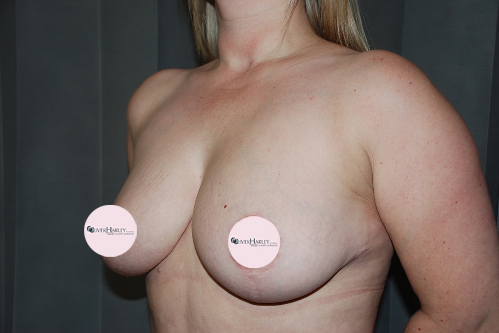 AS BU Breast Uplift Side After