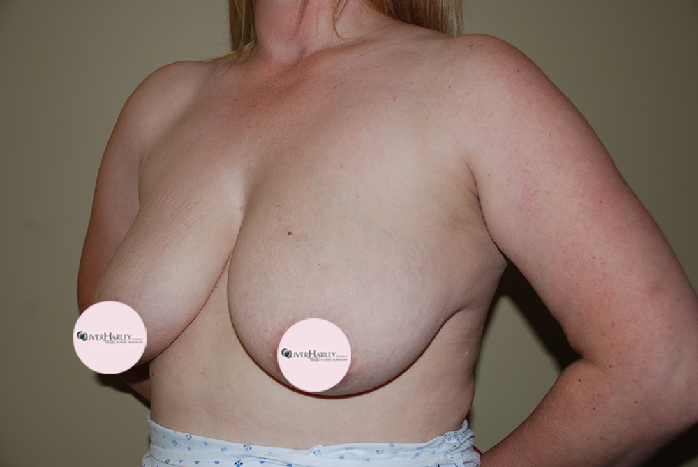AS BU Breast Uplift Side Before