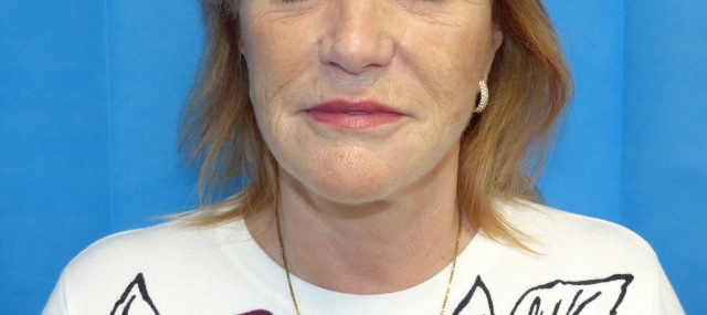 AS FLNL Face Lift Front After AS FLNL Face Lift Front After